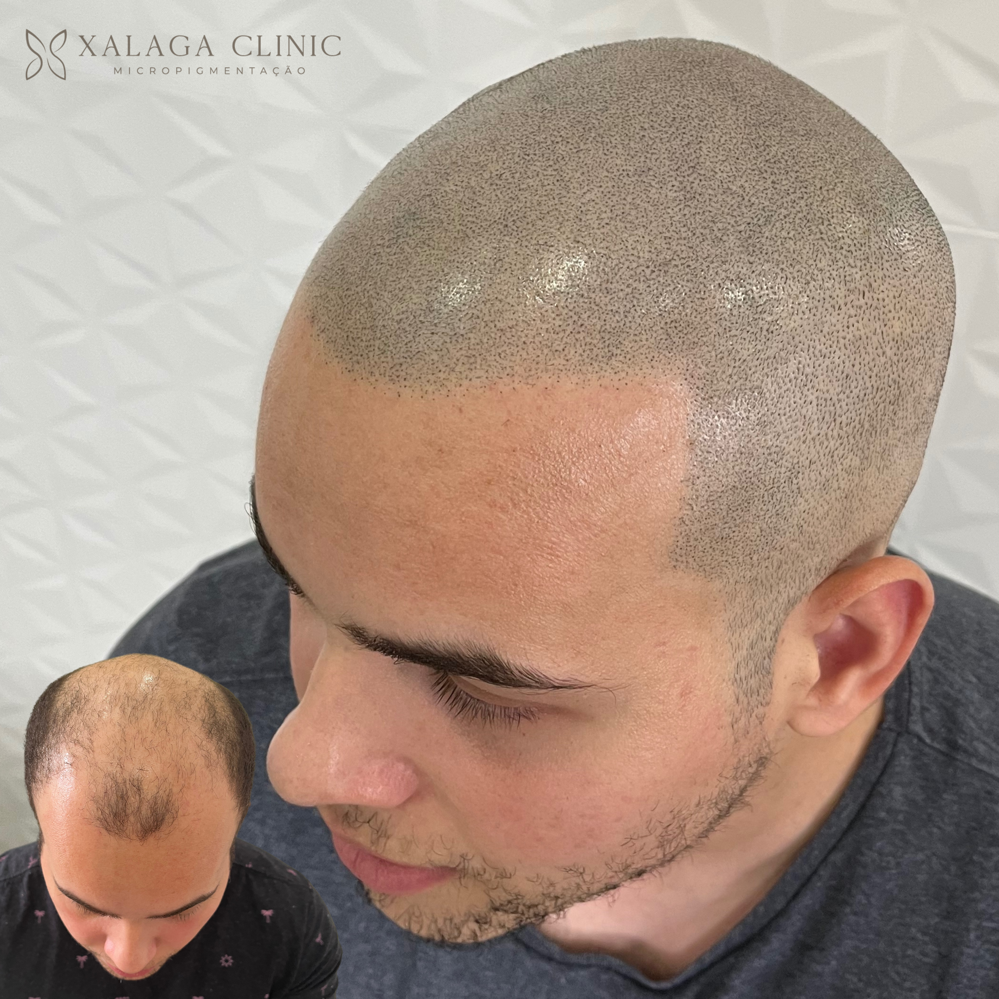 Micro Capilar Efeito Raspado